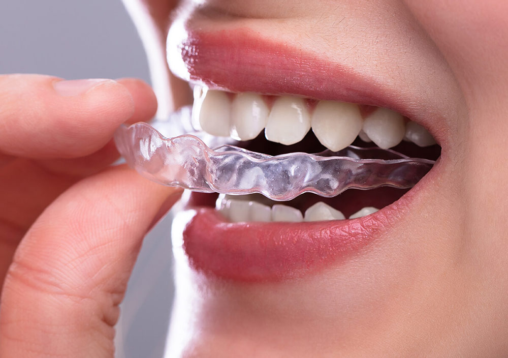 Quy trình thực hiện niềng răng invisalign ra sao?