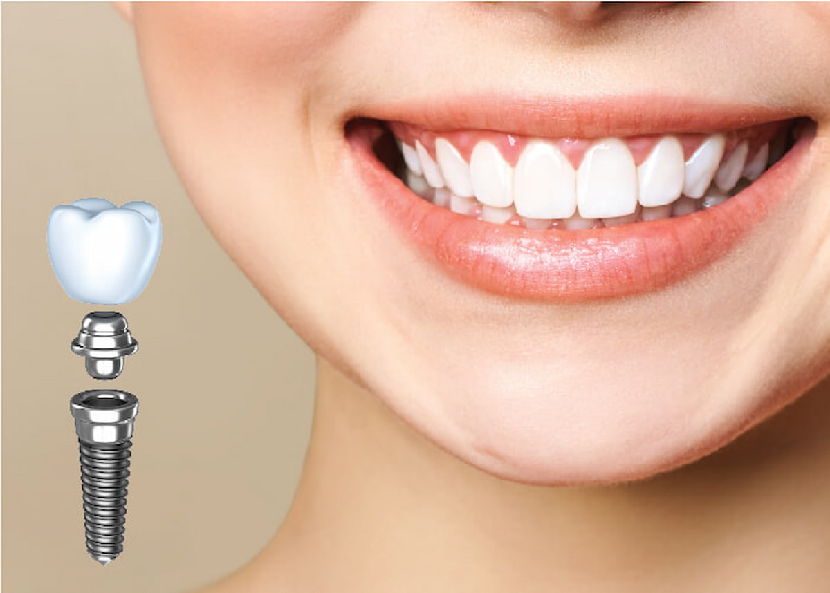 Trồng răng implant Đà Nẵng có đắt không?