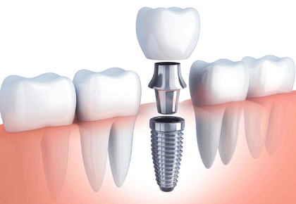 Trồng răng Implant là gì? Những lưu ý khi cấy ghép Implant