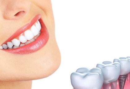 5 lợi ích khiến phương pháp trồng răng sứ Implant được yêu thích nhất