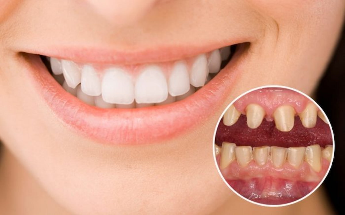 Những nguyên nhân hàng đầu khiến bọc răng sứ bị đen nướu