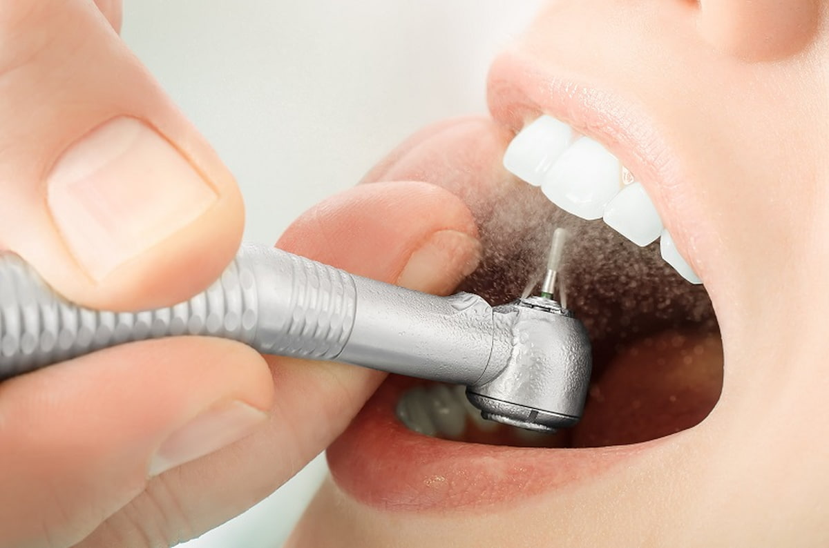 Cần mài nhỏ răng thật để làm trụ răng cho răng sứ
