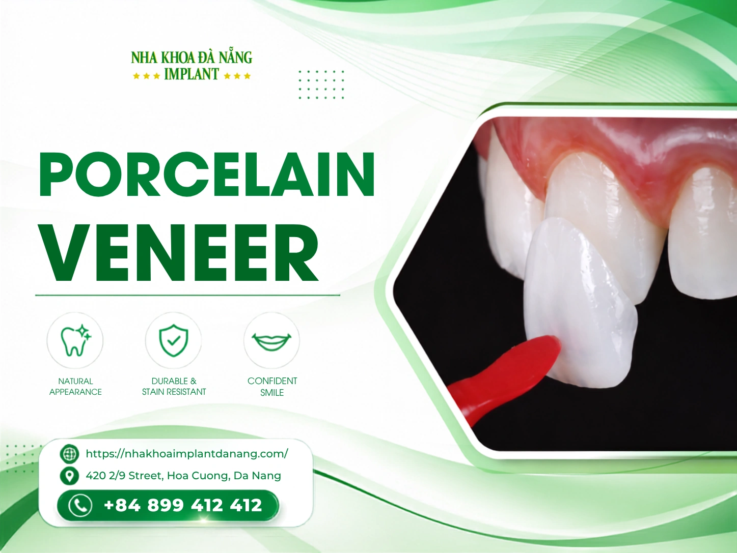 Porcelain veneers