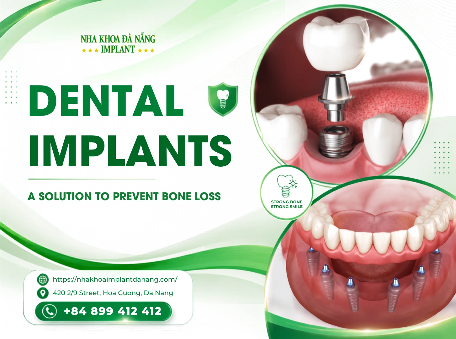 Dental Implants