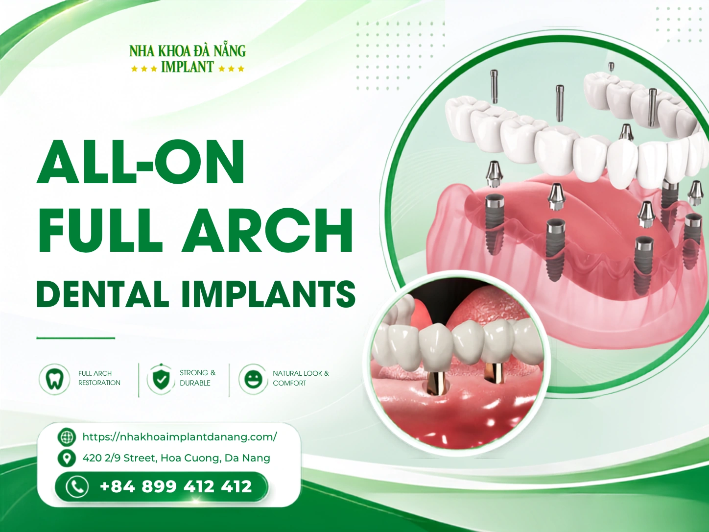 All-on-four/All-on-six Dental Implants