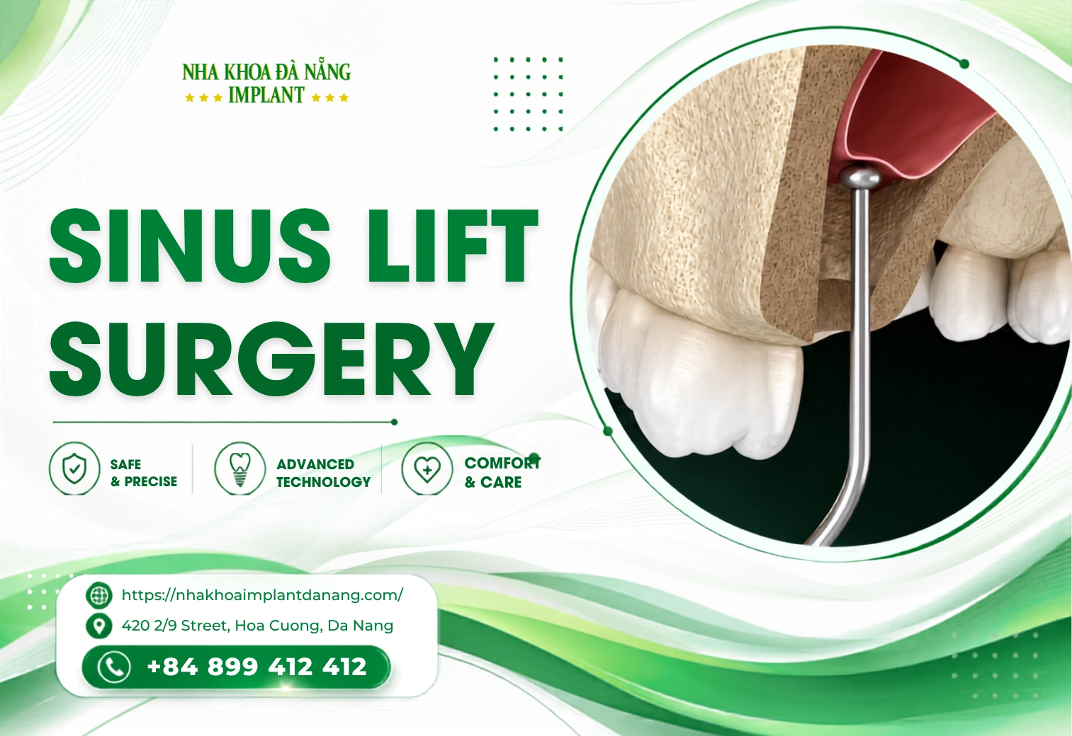 Sinus lift surgery