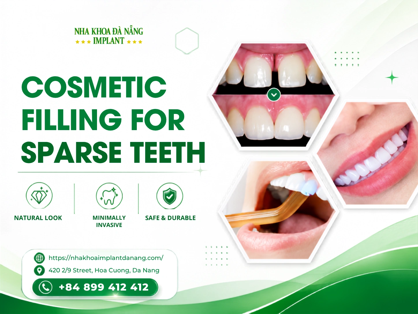 Cosmetic filling for sparse teeth