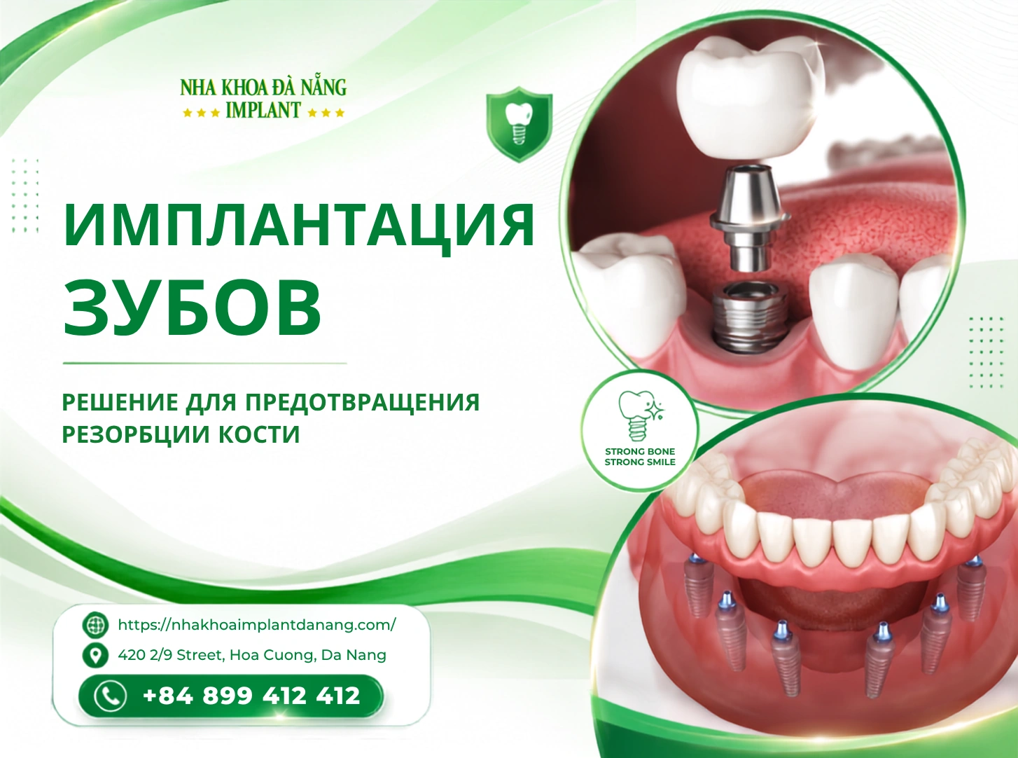 Имплантация зубов – решение для предотвращения резорбции кости