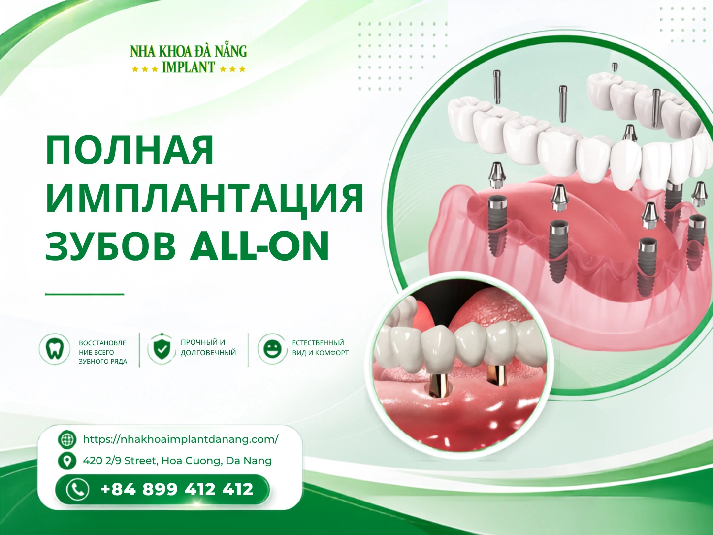 Полная имплантация зубов All-on