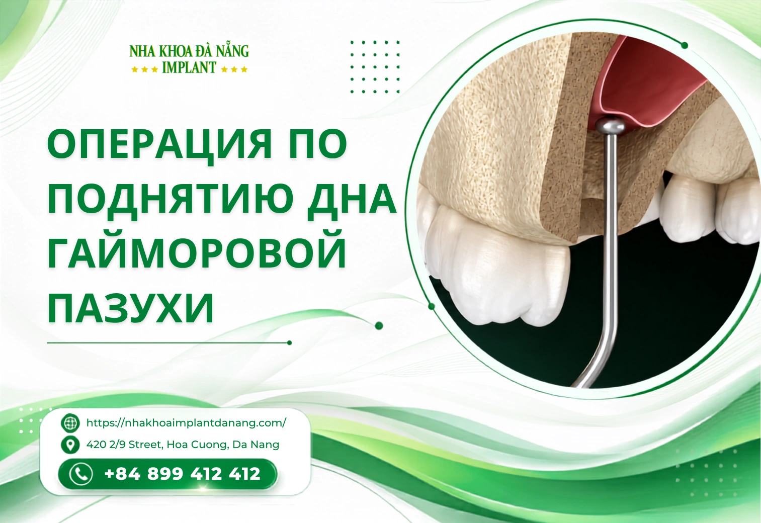 Операция по поднятию дна гайморовой пазухи