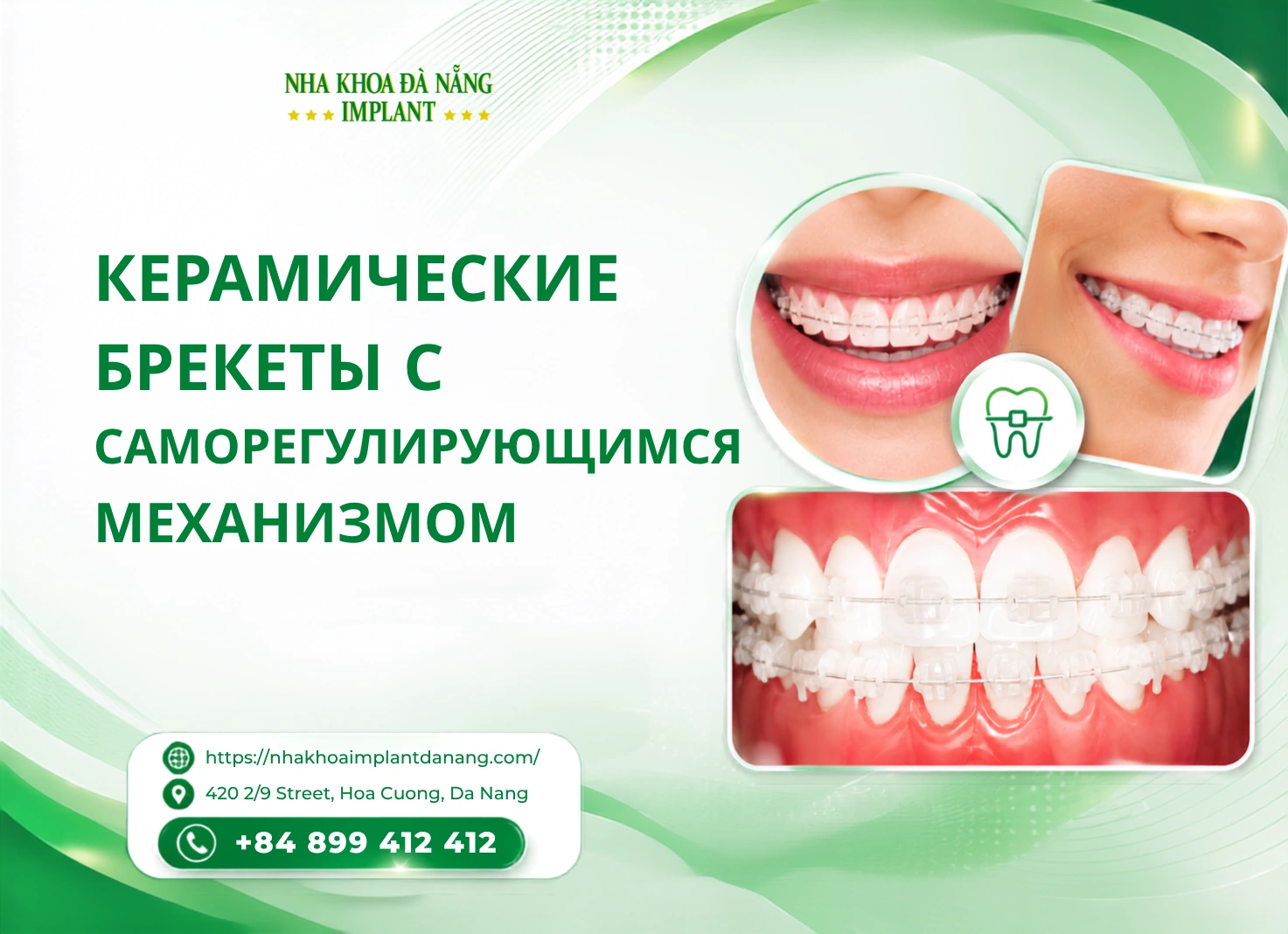 Керамические брекеты с саморегулирующимся механизмом