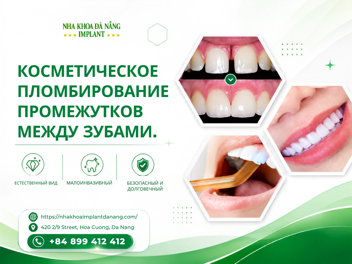 Эстетическая пломба для лечения промежутков между зубами