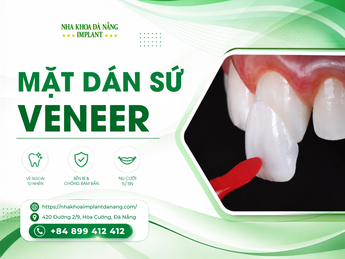 Mặt dán sứ Veneer