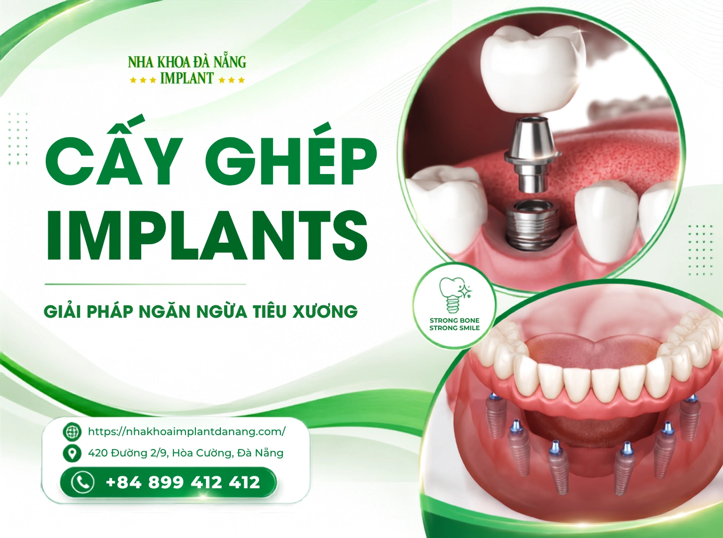 Cấy ghép răng Implant giải pháp ngăn ngừa tiêu xương