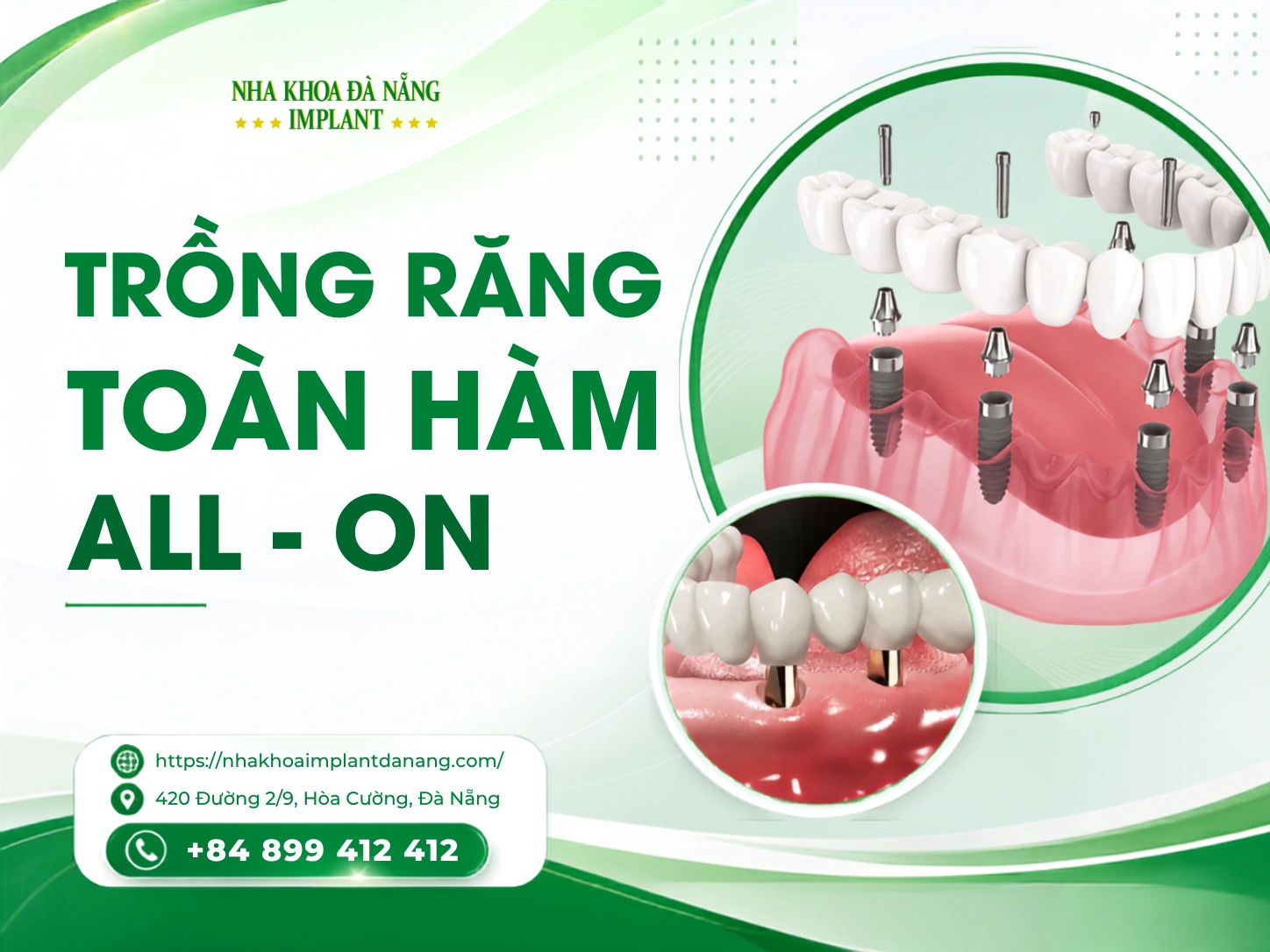 Trồng răng toàn hàm All on