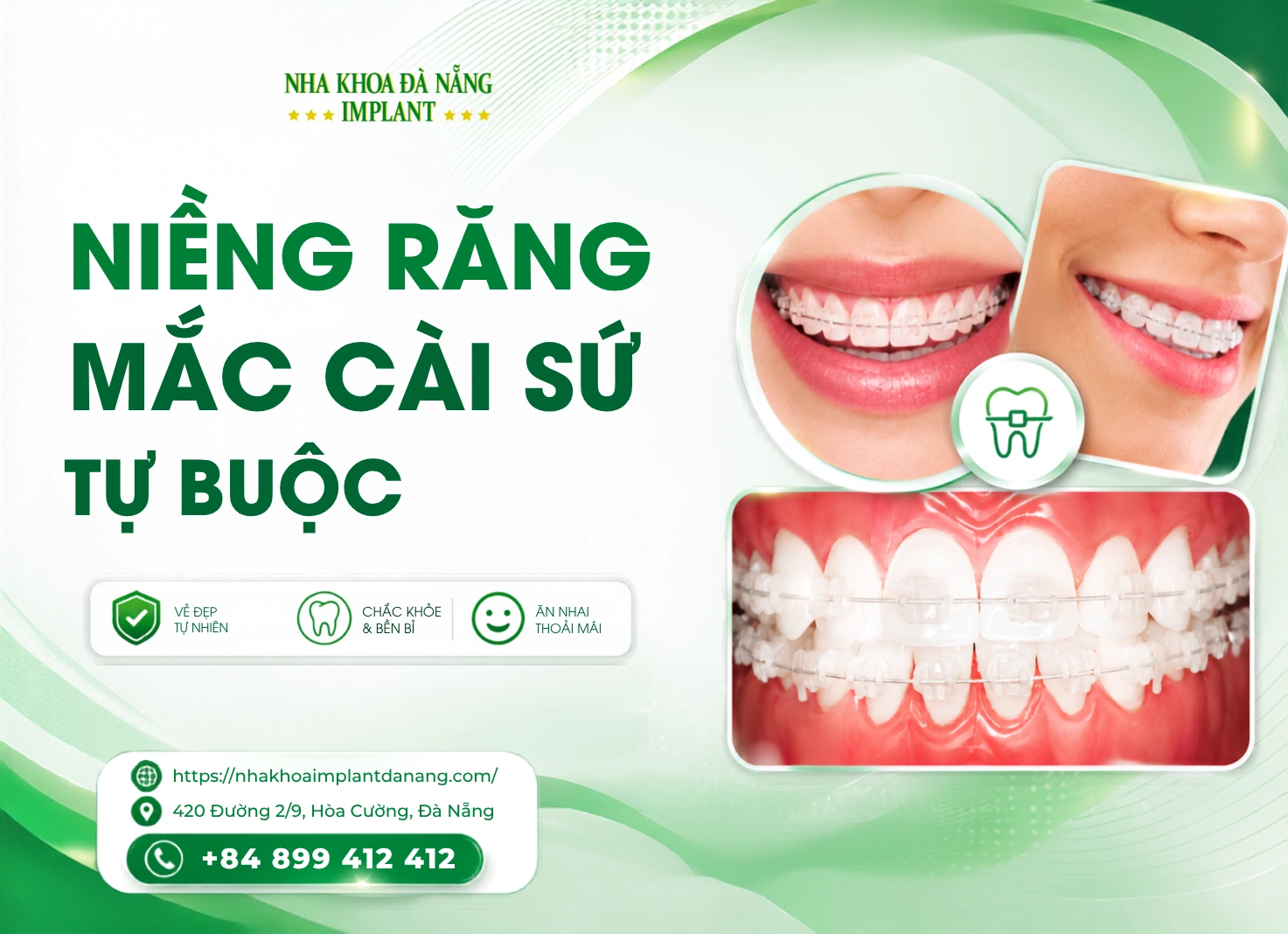Niềng răng mắc cài sứ tự buộc