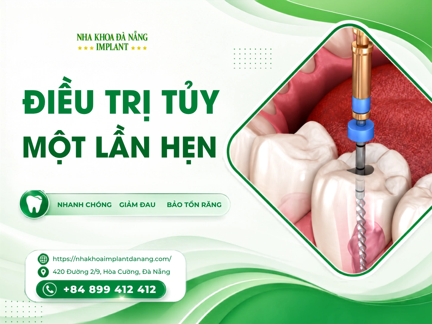 Điều trị tuỷ răng một lần hẹn