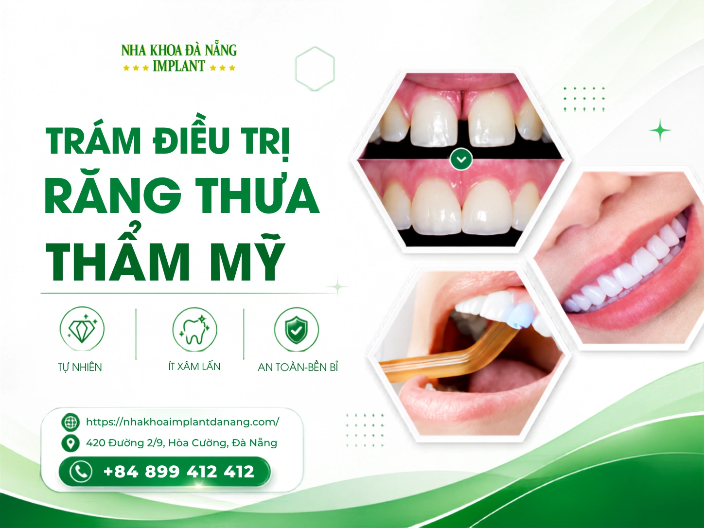 Trám điều trị răng thưa thẩm mỹ