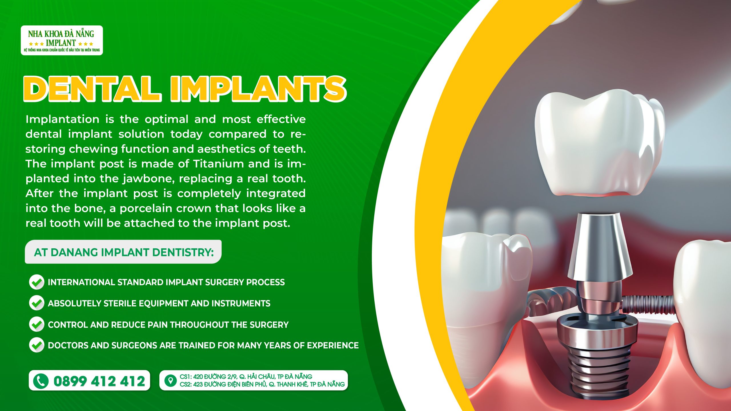 Dental Implants