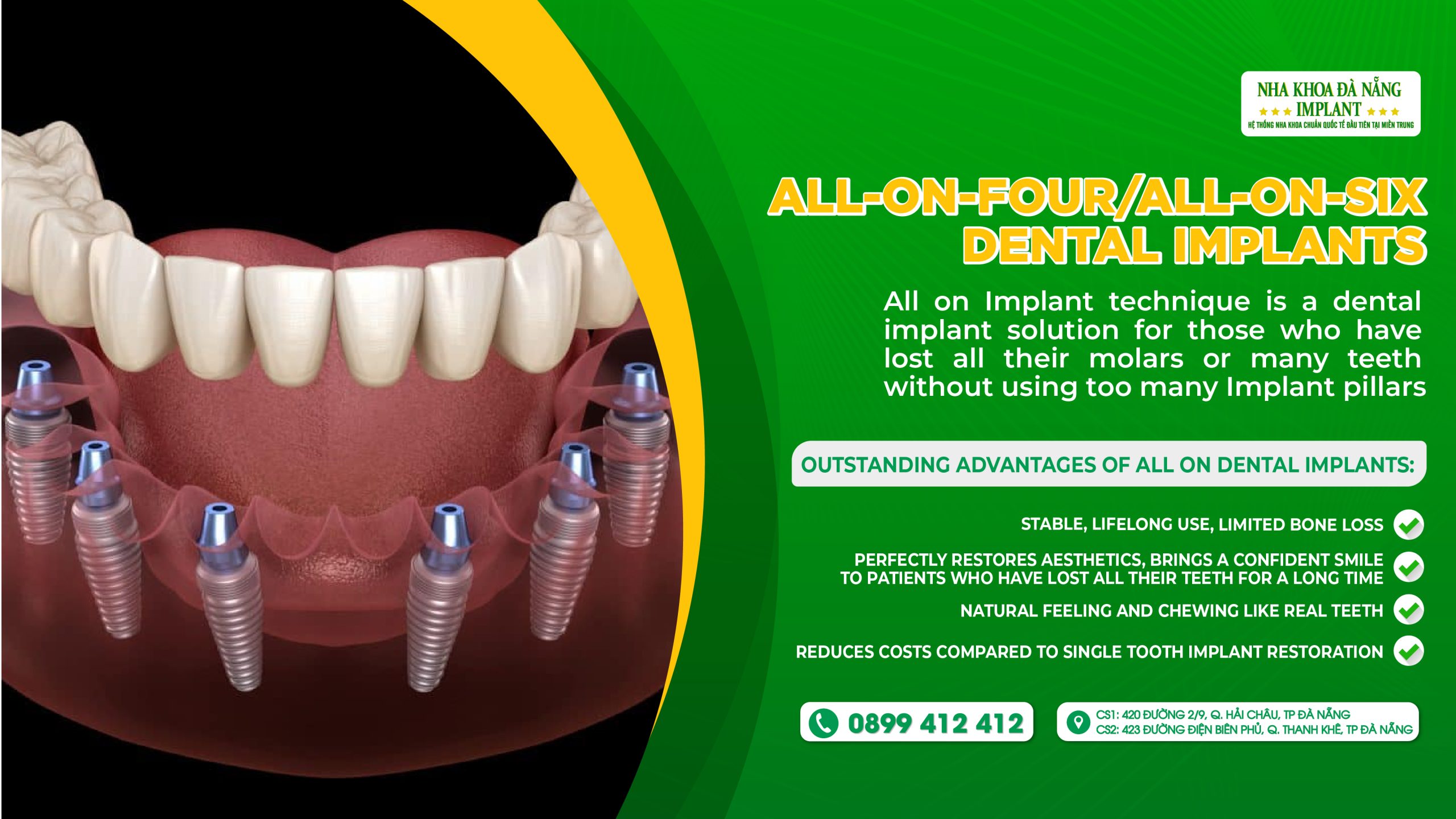 All-on-four/All-on-six Dental Implants