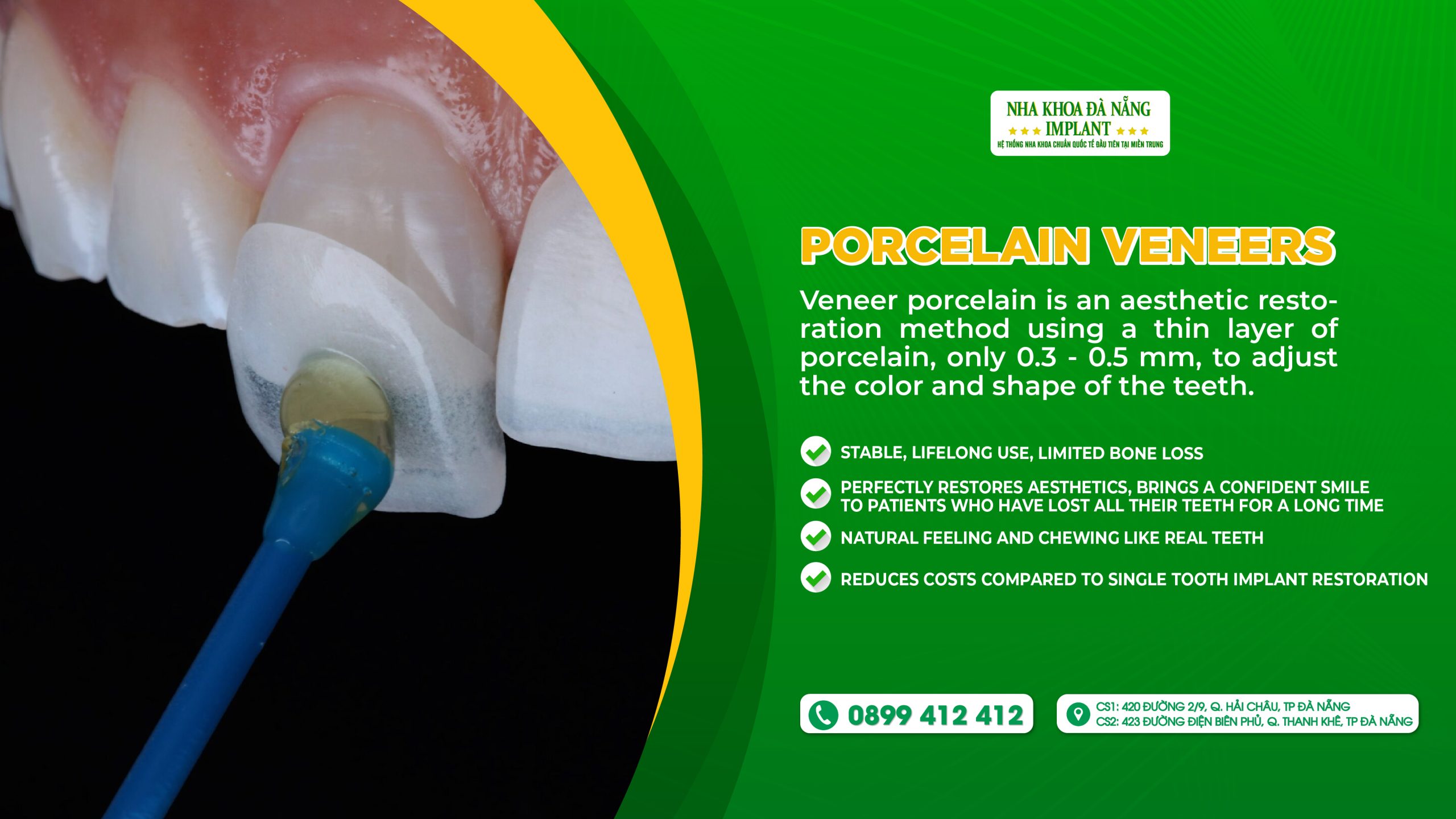 Porcelain veneers