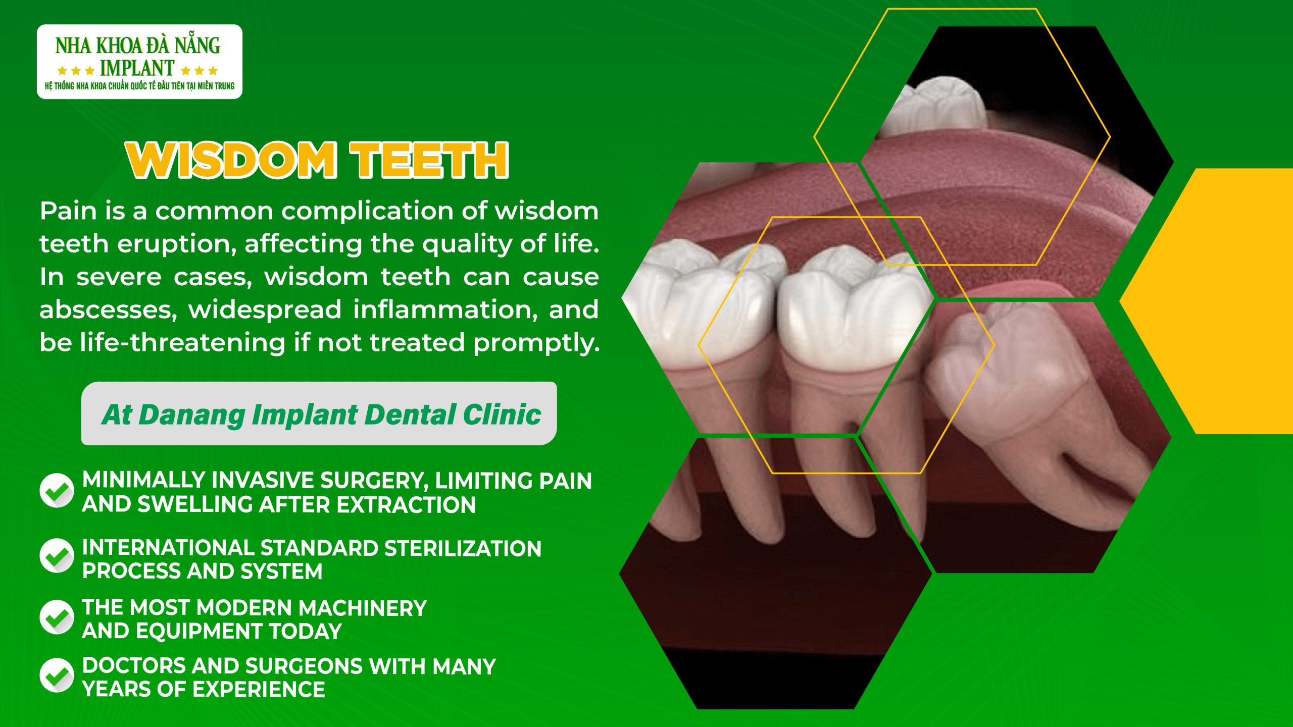 Extraction of teeth 8 (wisdom teeth)