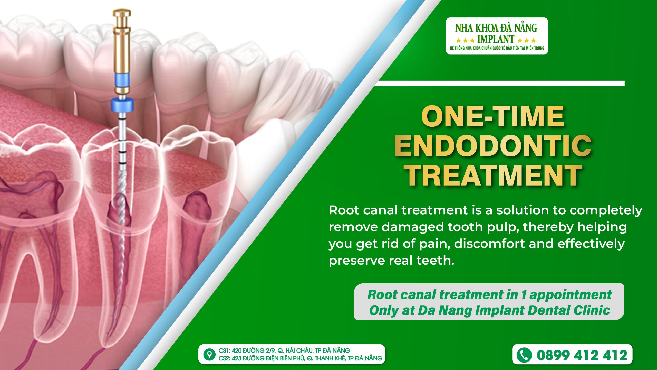 One-time endodontic treatment