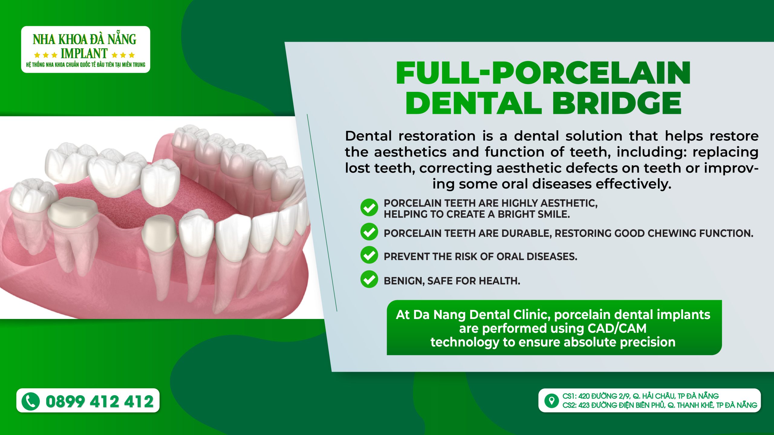 Full-porcelain Dental Bridge