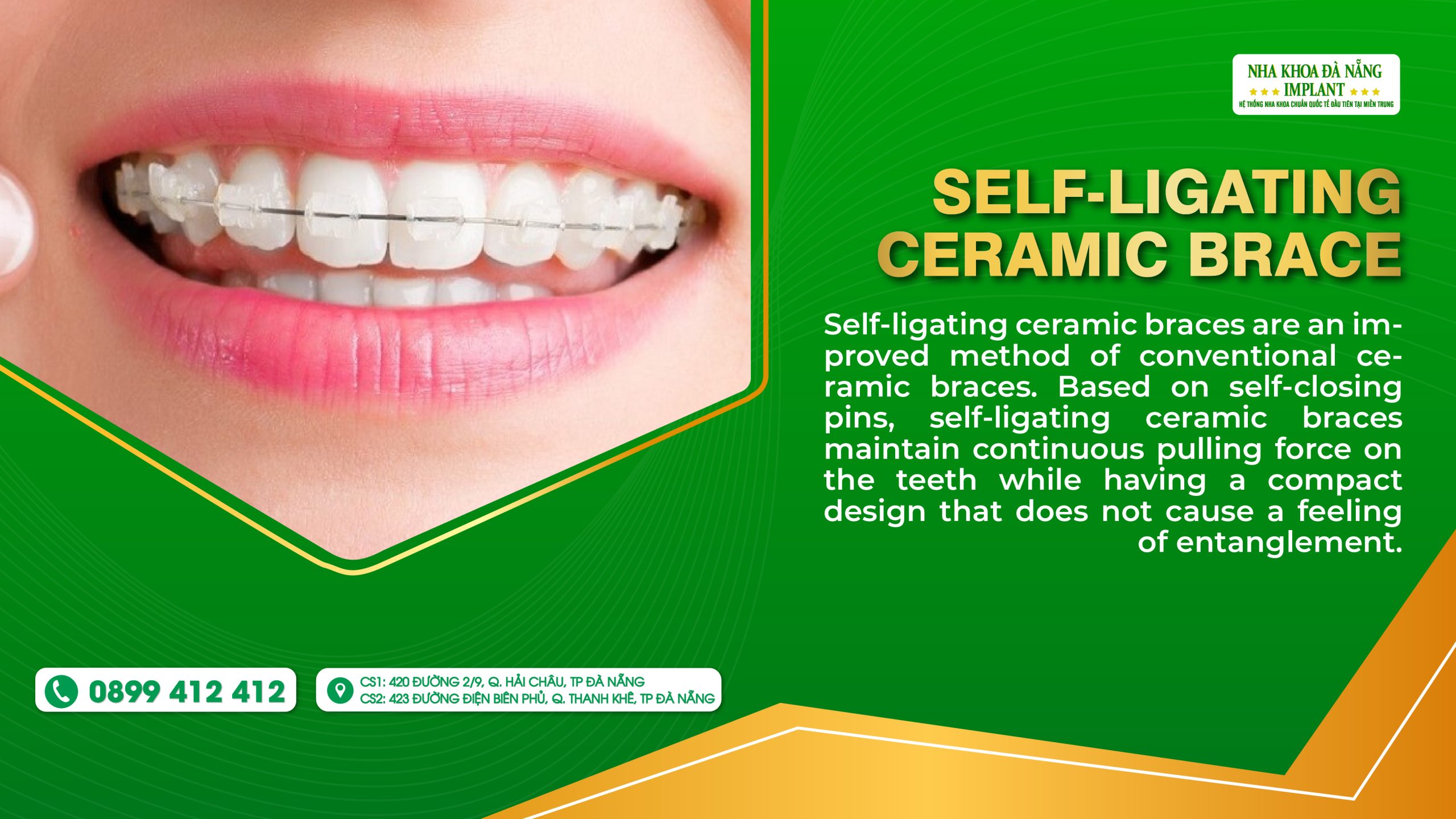 Self-ligating Ceramic Brace