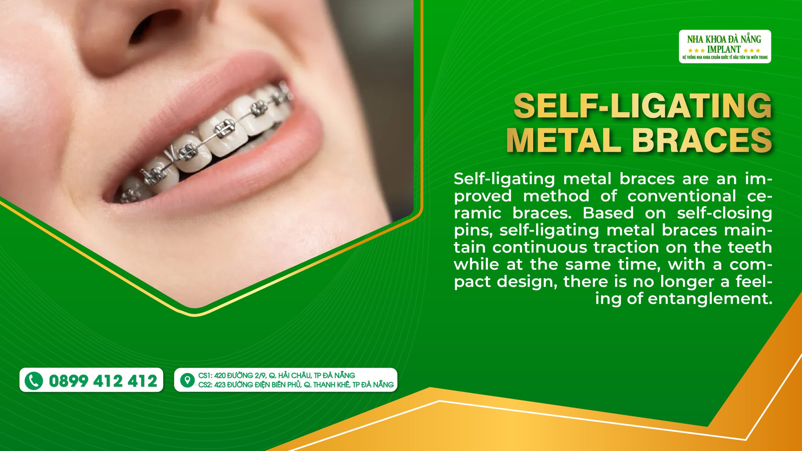 Self-ligating Medal Braces