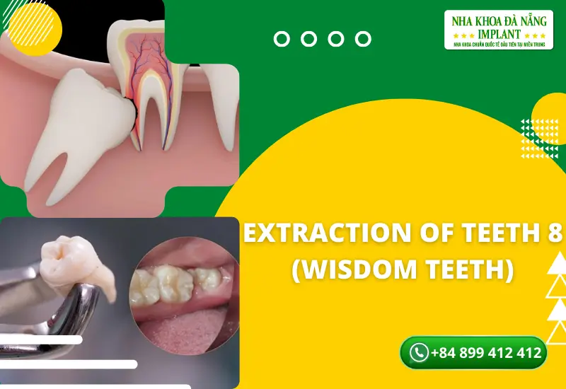 Extraction of teeth 8 (wisdom teeth)