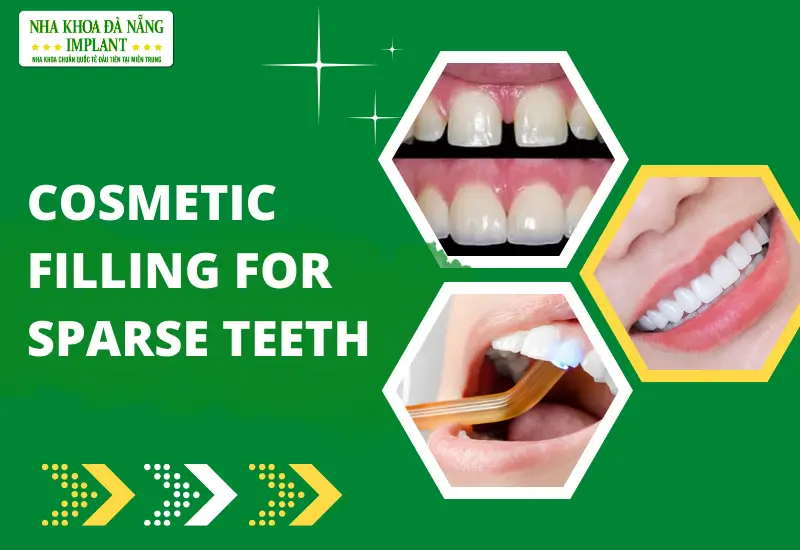 Cosmetic filling for sparse teeth