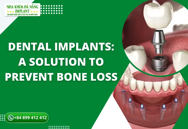 Dental Implants