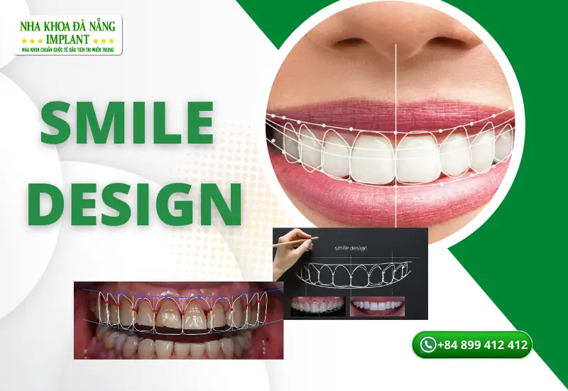 Smile design