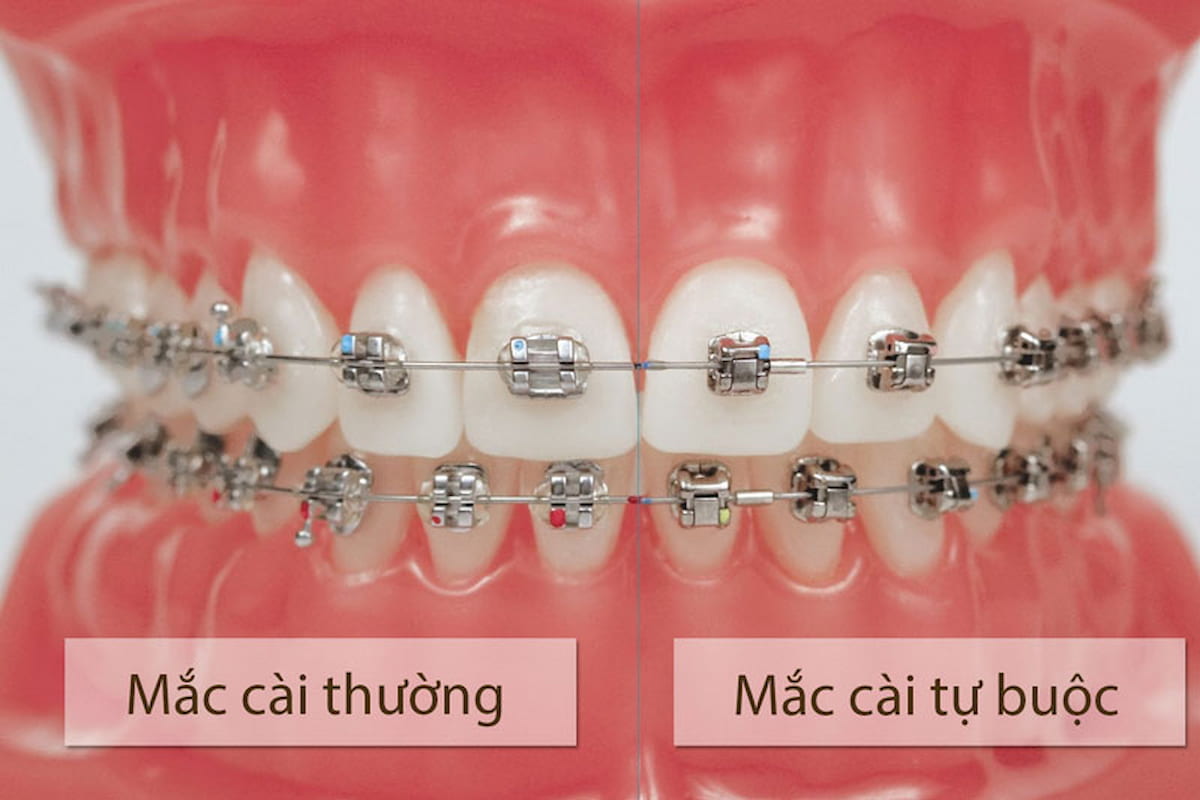 The difference between traditional braces and self-ligating braces