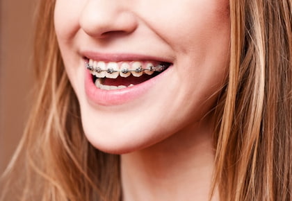 Niềng răng mắc cài kim loại tự buộc là gì?