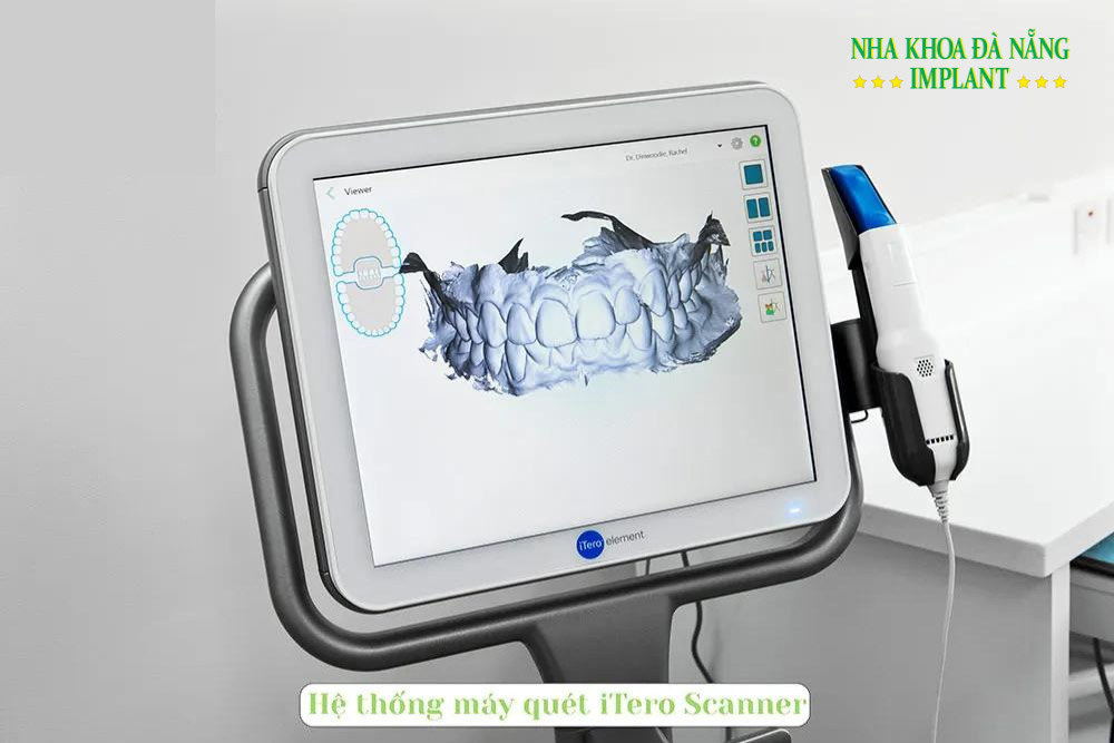 Hệ thống máy quét iTero Scanner