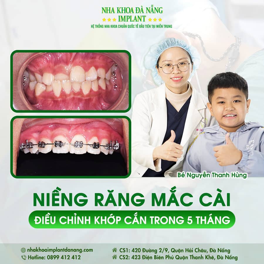 Niềng răng mắc cài kim loại tại Nha khoa Đà Nẵng Implant