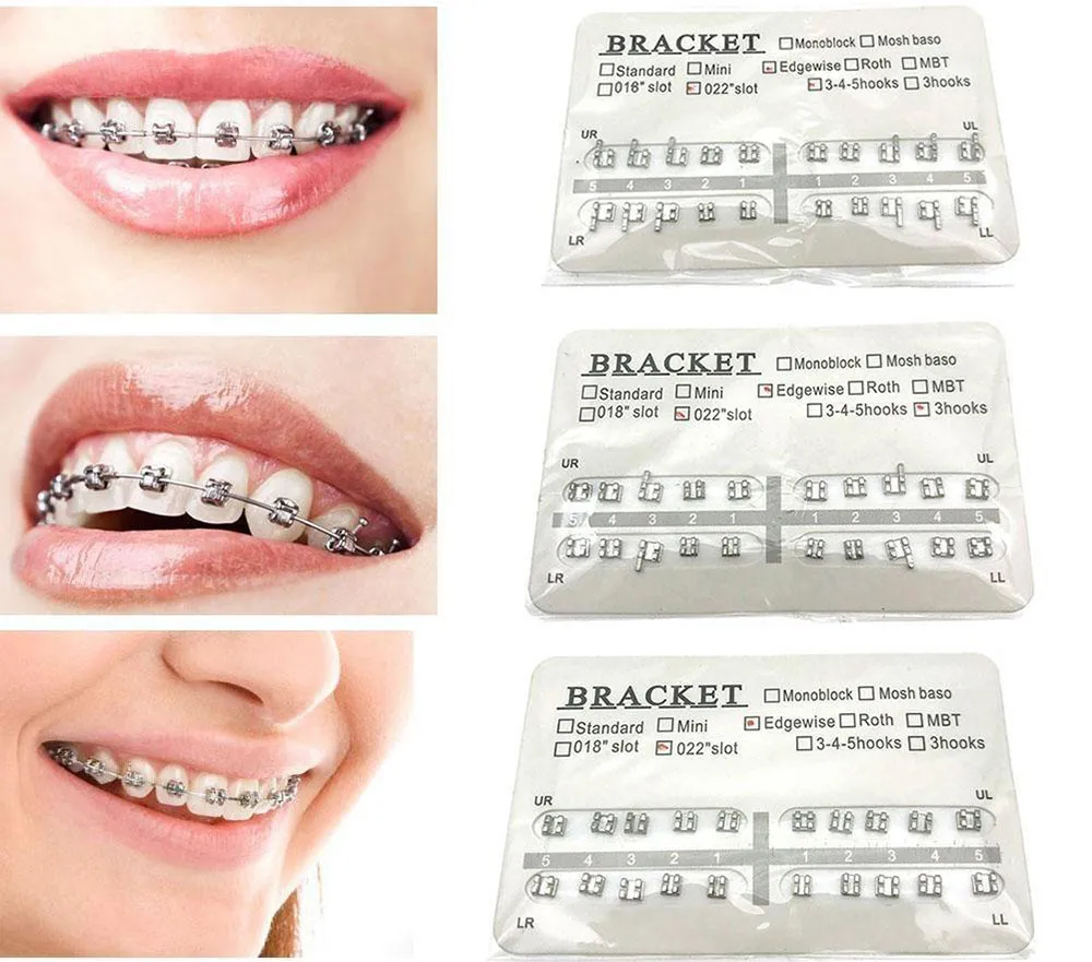  Niềng răng bằng mắc cài kim loại có ảnh hưởng sức khỏe không?