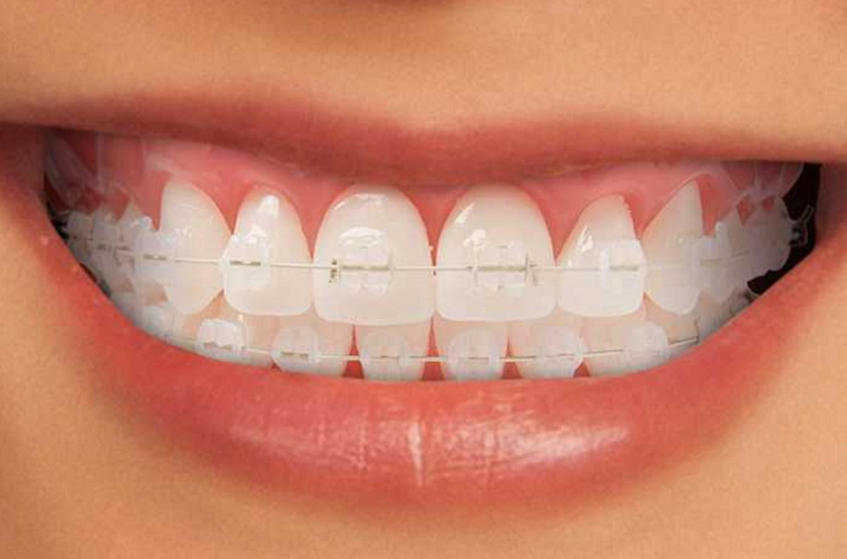 So sánh niềng răng mắc cài sứ tự buộc và niềng răng mắc cài kim loại tự buộc
