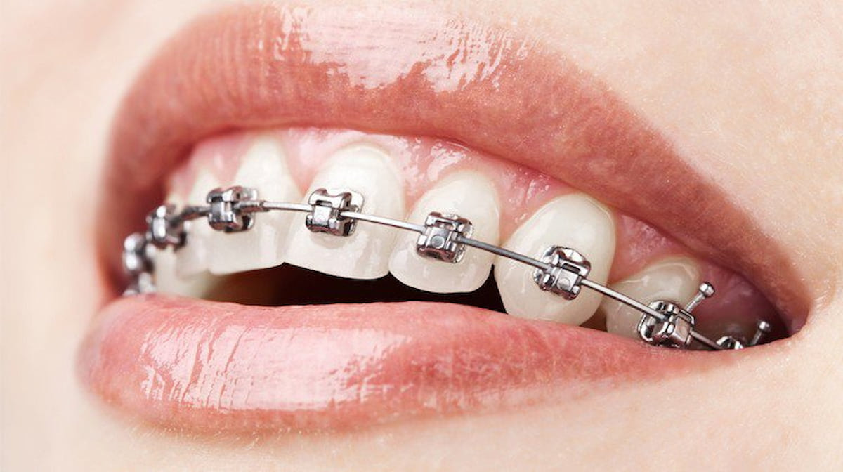 So sánh niềng răng mắc cài sứ tự buộc và niềng răng mắc cài kim loại tự buộc