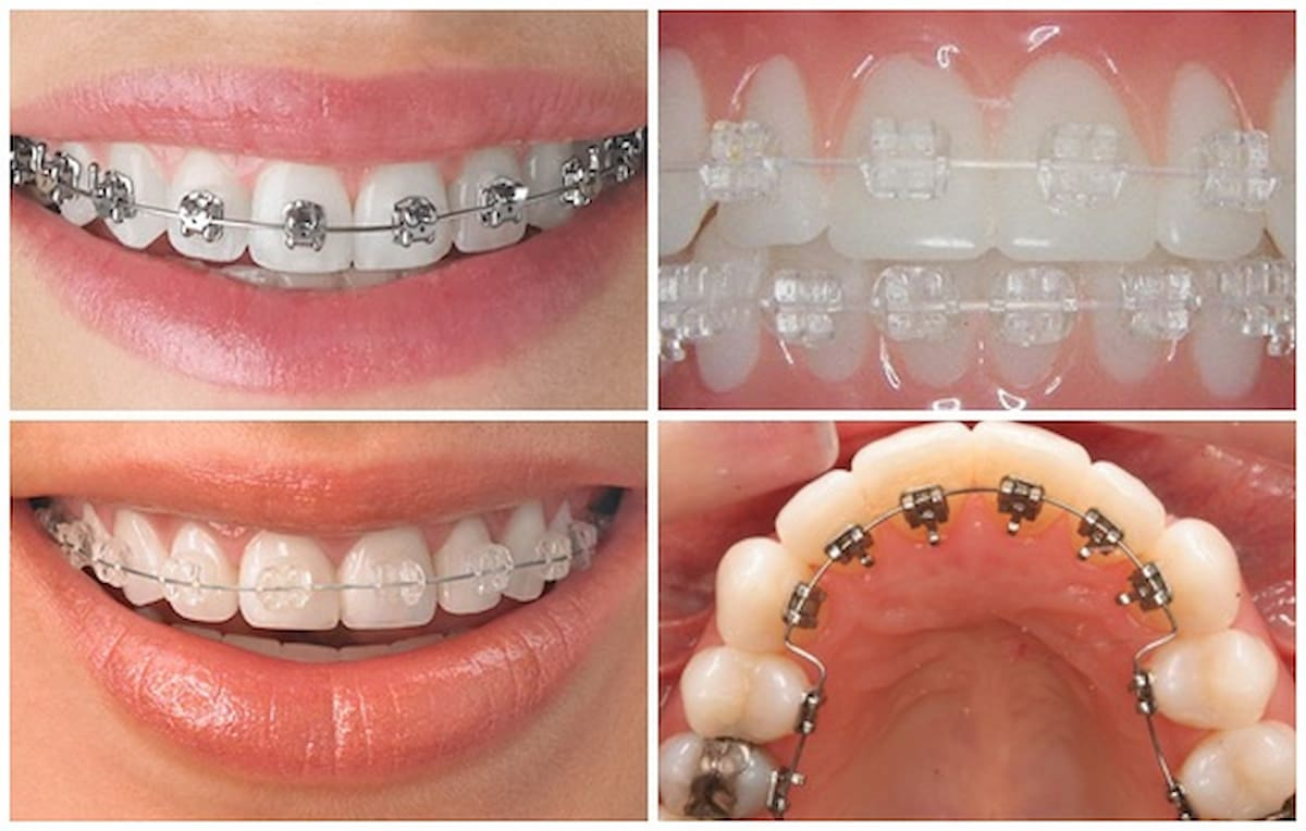 The two methods of braces have differences in: treatment time, level of irritation, aesthetics, cost,...
