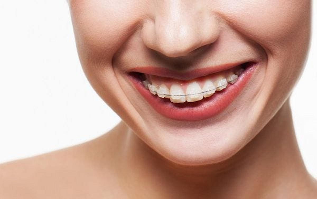 3 yếu tố giúp niềng răng Đà Nẵng an toàn không đau tiết kiệm