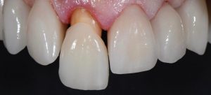 Nguyên nhân và cách điều trị răng cửa mọc lệch