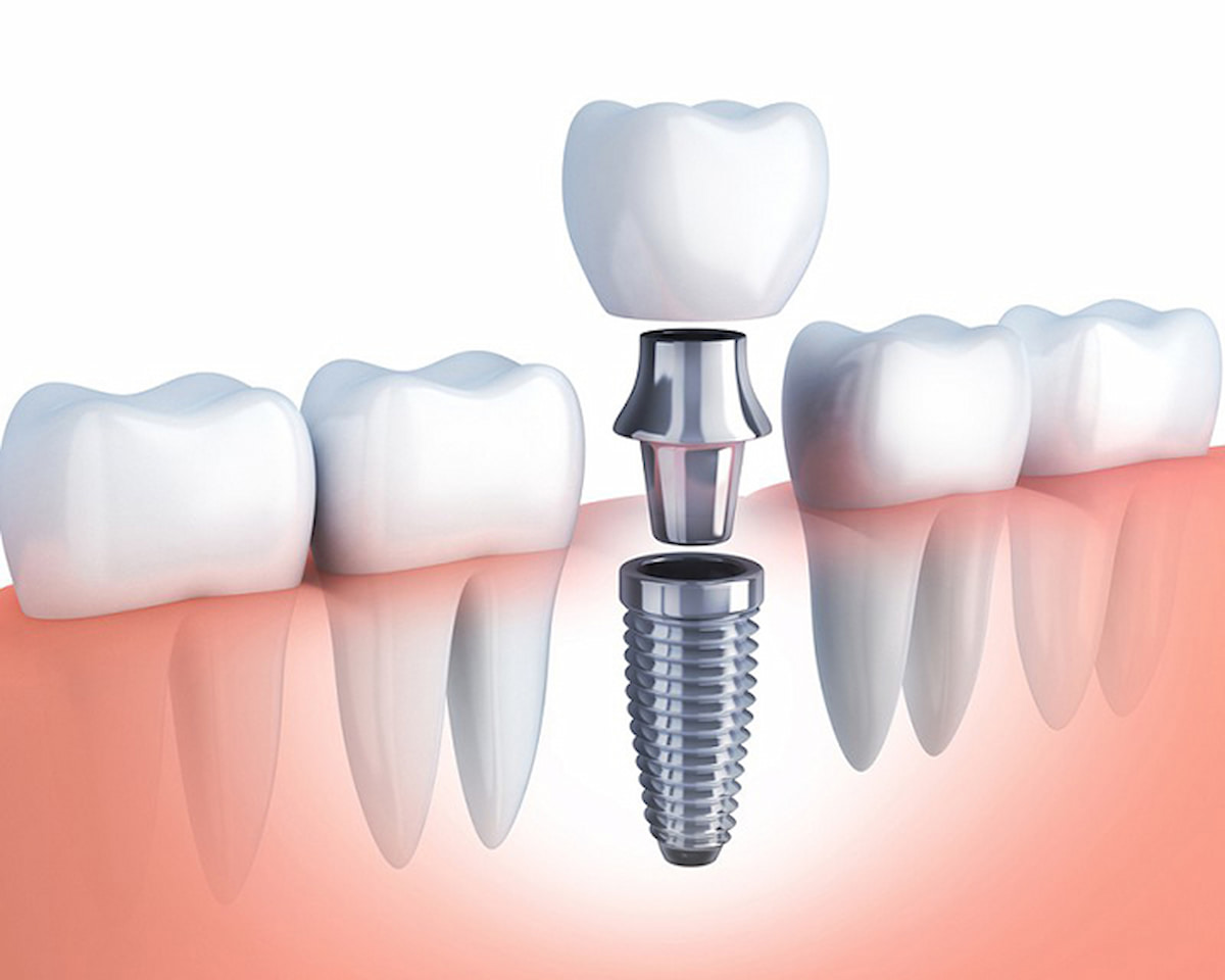 Trồng răng sứ cố định bằng chất liệu gì tốt?