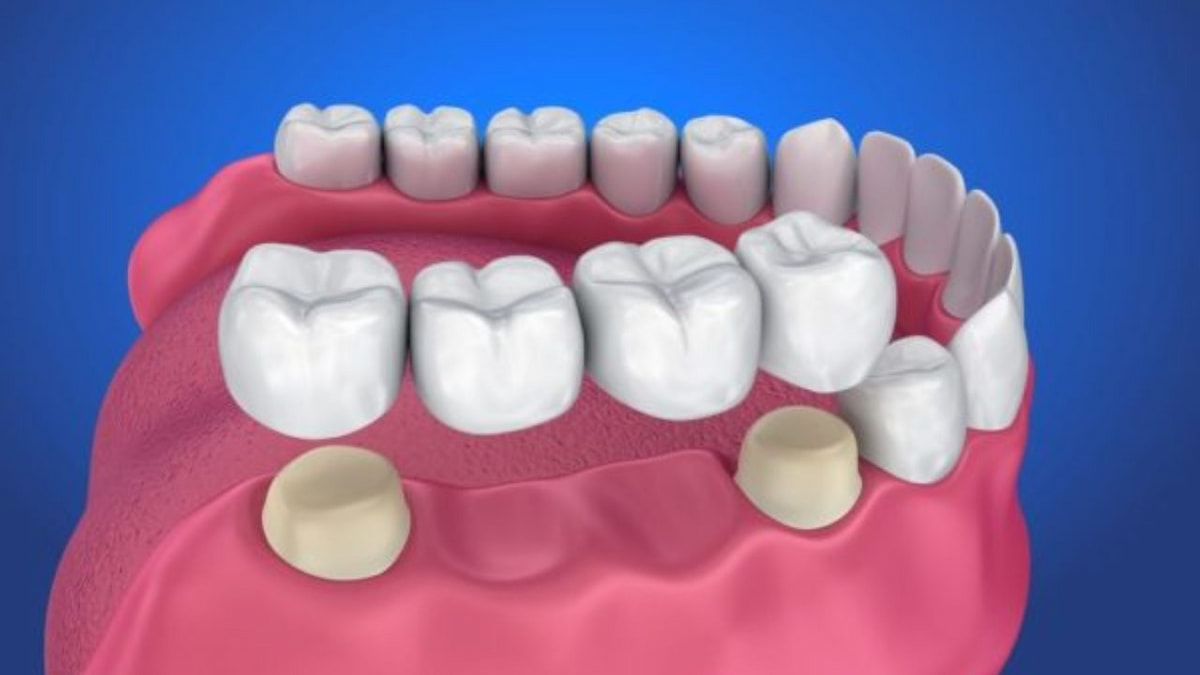 Trồng răng sứ vĩnh viễn có đau không? Cách trồng răng sứ không đau