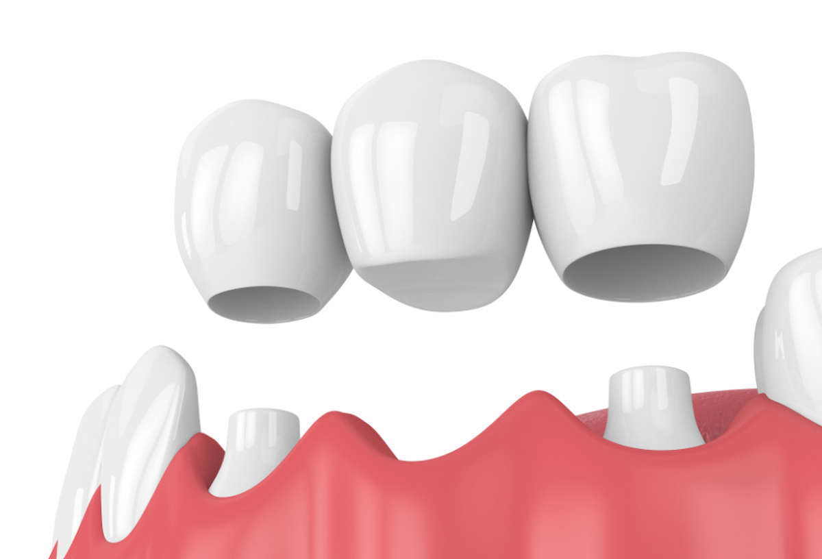 Trồng răng sứ cố định bằng chất liệu gì tốt?