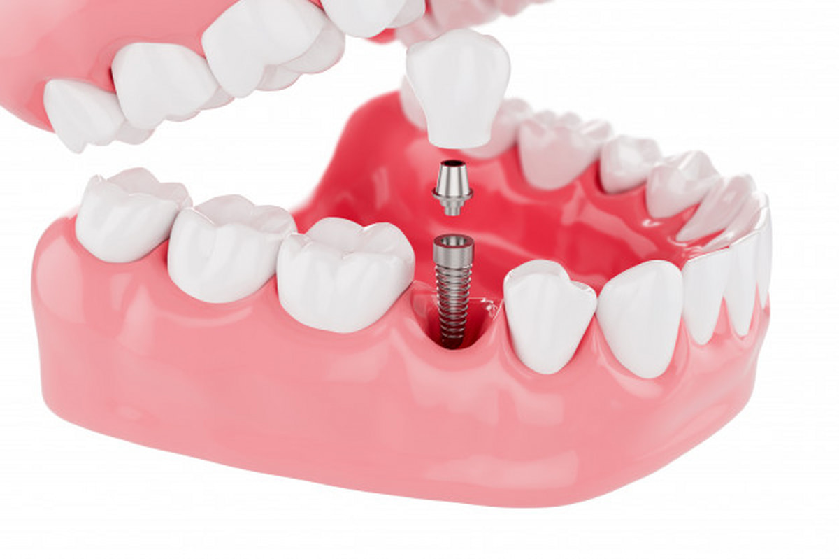 Những nhược điểm của trồng răng implant bạn nên biết