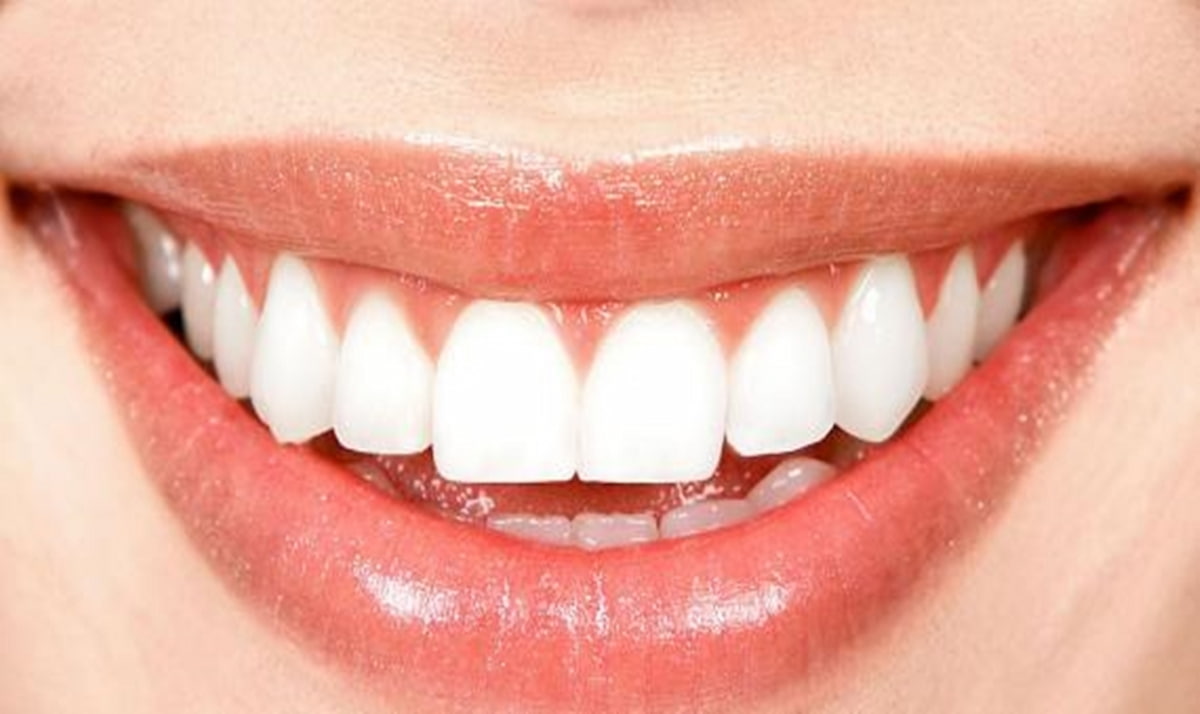 Những yếu tố giúp răng bọc sứ titan kéo dài tuổi thọ - Phần 2