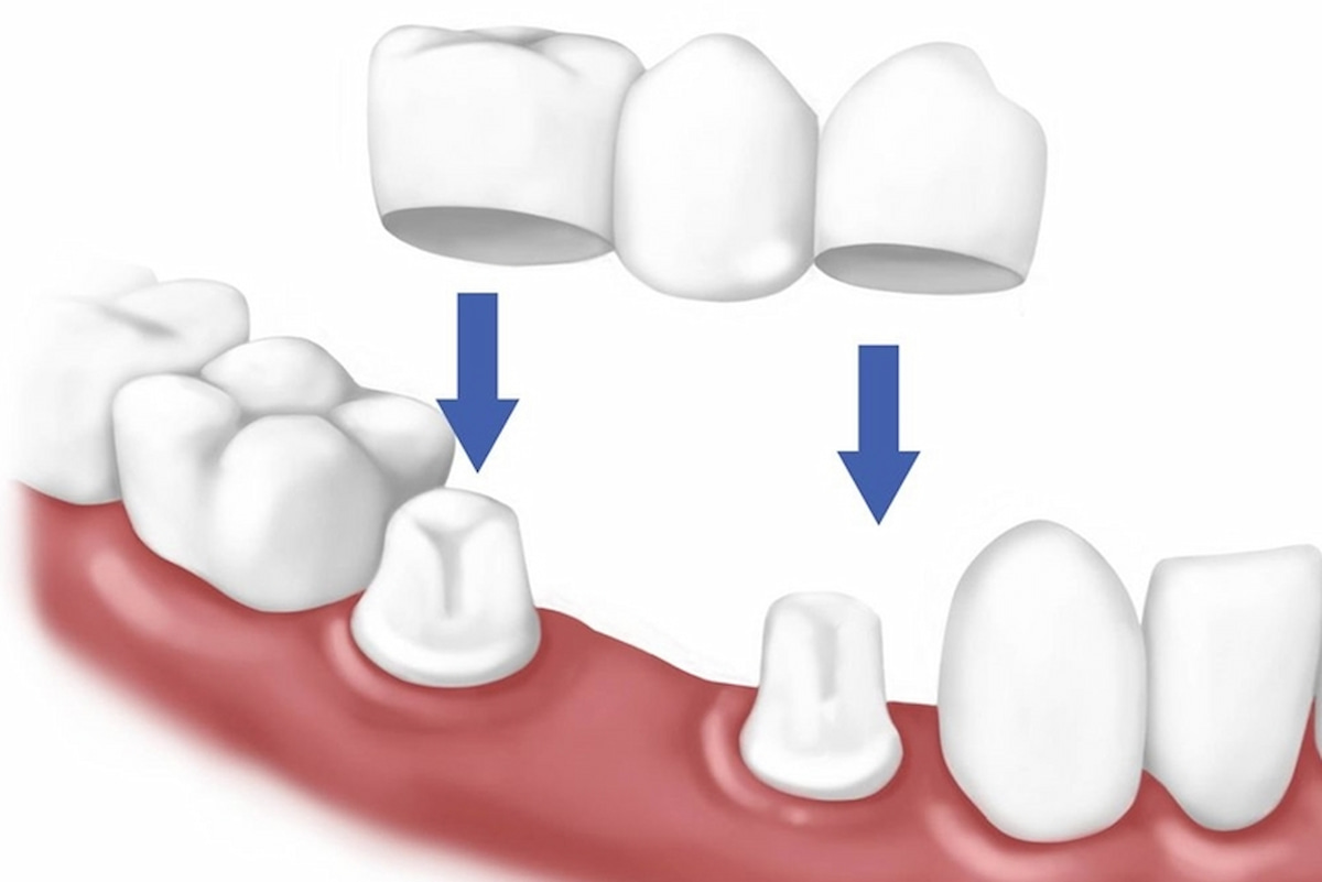 Răng toàn sứ loại nào tốt nhất? Cách lựa chọn răng toàn sứ tốt